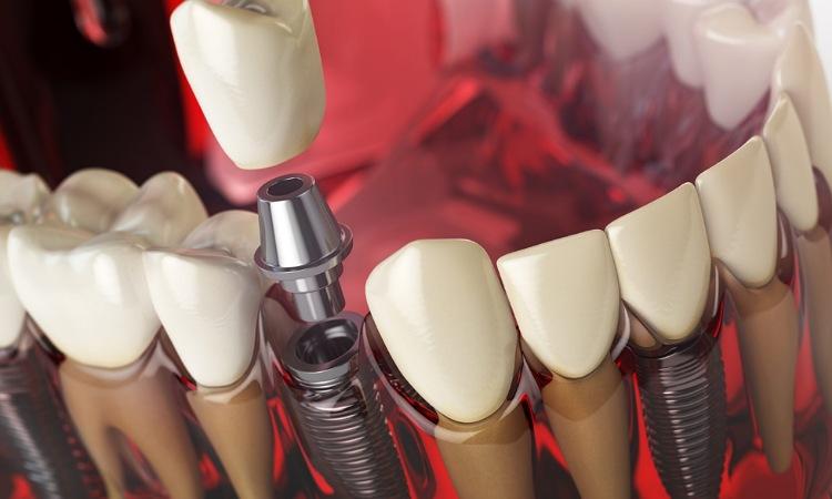ایمپلنت دندان؛ قیمت، انواع، فواید و عوارض