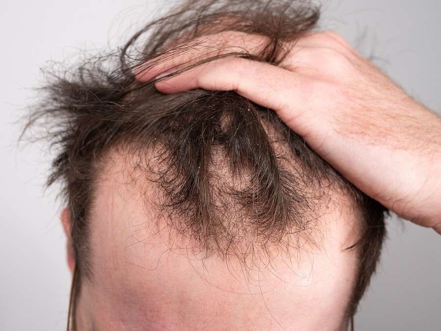 ریزش موی پس از کرونا 
