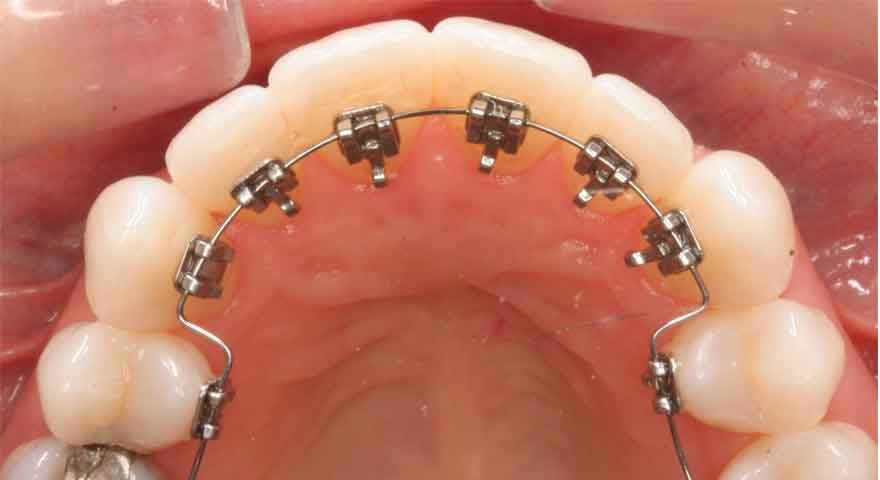 مراحل مختلف ارتودنسی دندان